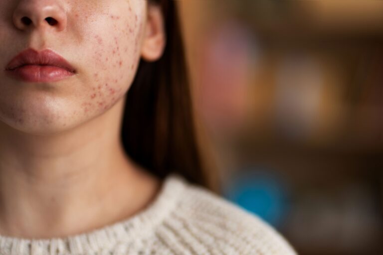 person-dealing-with-rosacea (1)